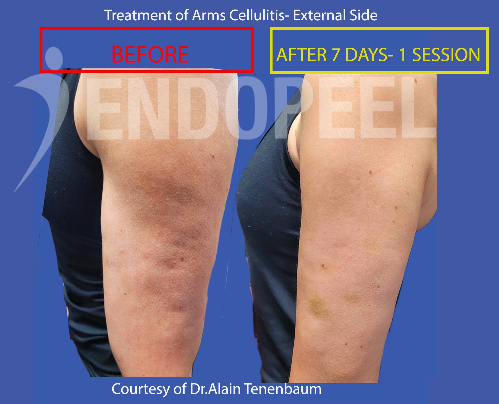 arms-cellulitis